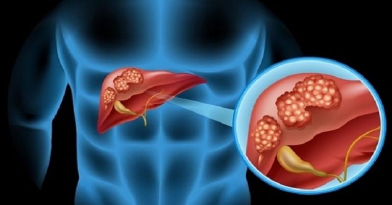 Colangiocarcinoma, il tumore che si sviluppa molto rapidamente: ecco come riconoscerlo