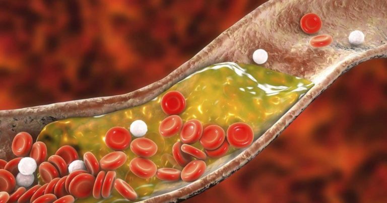 Colesterolo alto, ecco quali sono i 5 sintomi cui prestare attenzione