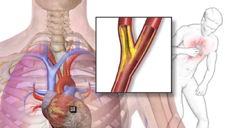 Angina pectoris, attenzione a questi sintomi caratteristici