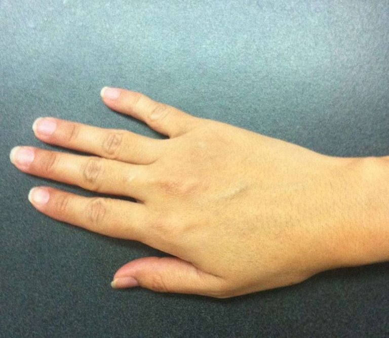 Formicolio alle dita delle mani: ecco quando è necessario rivolgersi al medico Formicolio alle dita delle mani: ecco quando è necessario rivolgersi al medico