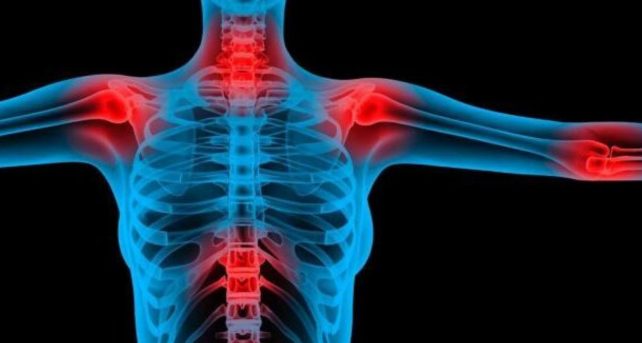 fibromialgia