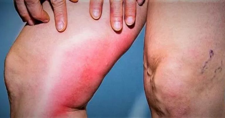 Trombosi venosa profonda, ecco quali sono i sintomi che non vanno ignorati Trombosi venosa profonda, ecco quali sono i sintomi che non vanno ignorati