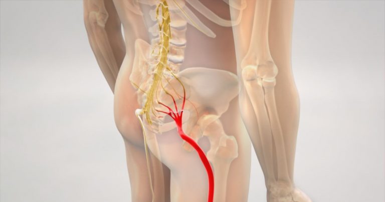 Sciatica, il dottor Fornari svela il dolore tipico e come curarla