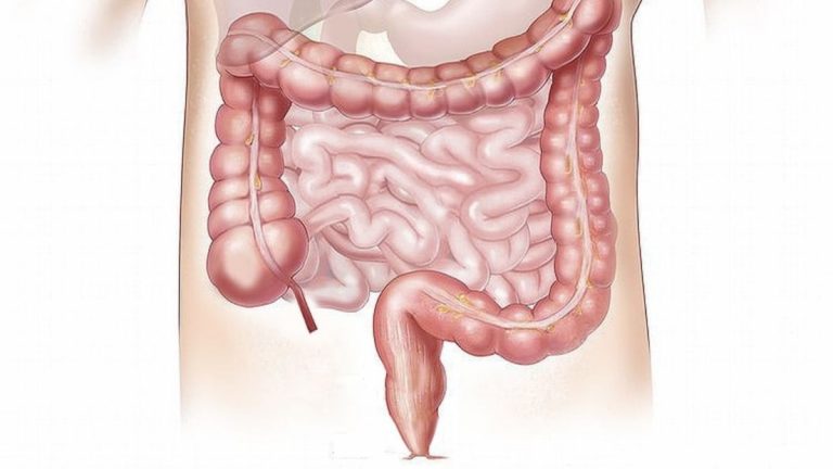 Tumore del colon-retto, attenzione a questo sintomo: è il più comune Tumore del colon-retto, attenzione a questo sintomo: è il più comune