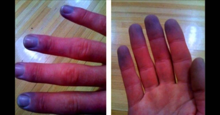Hai mani e piedi sempre freddi? Ecco quando bisogna preoccuparsi Hai mani e piedi sempre freddi? Ecco quando bisogna preoccuparsi