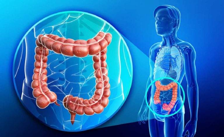 Tumore al colon retto, se mangi questi alimenti puoi prevenirlo Tumore al colon retto, se mangi questi alimenti puoi prevenirlo