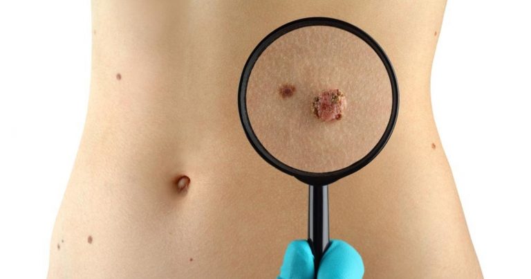 Tumore della pelle, attenzione a questo strano e raro sintomo: può essere il segnale di un melanoma