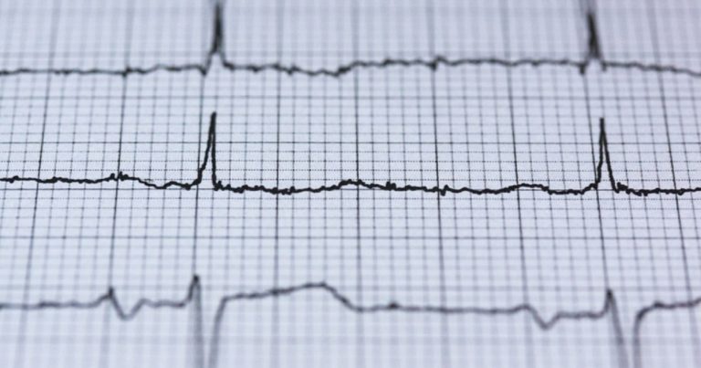 Fibrillazione atriale, ecco quali sono i sintomi da riconoscere per evitare ictus e infarto