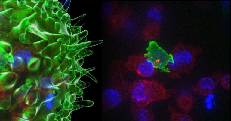 Tumore alla vescica: attenzione a questo strano sintomo. Ecco come riconoscerlo