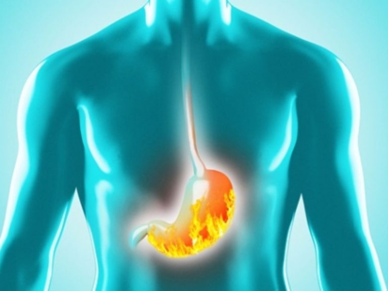 Reflusso gastro-esofageo, attenzione a questi sintomi atipici