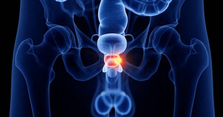 Tumore alla prostata, i due sintomi da non sottovalutare assolutamente Tumore alla prostata, i due sintomi da non sottovalutare assolutamente