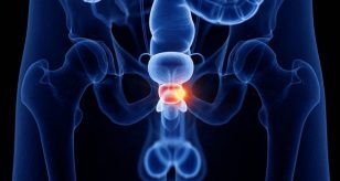 tumore prostata