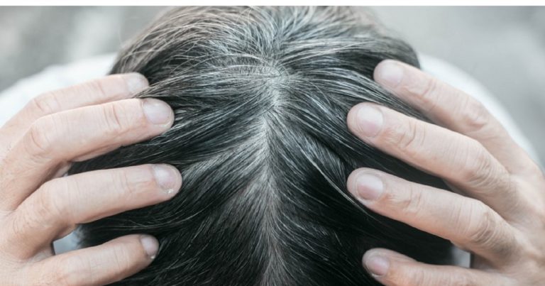 Caduta dei capelli, quali integratori assumere per rafforzare i capelli ed evitarne la perdita Caduta dei capelli, quali integratori assumere per rafforzare i capelli ed evitarne la perdita