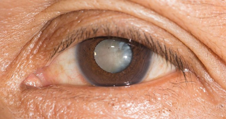 Cataratta, ecco i primi sintomi di problemi alla vista