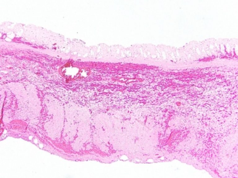 Infarto intestinale, ecco come riconoscerlo in tempo: i sintomi da non sottovalutare