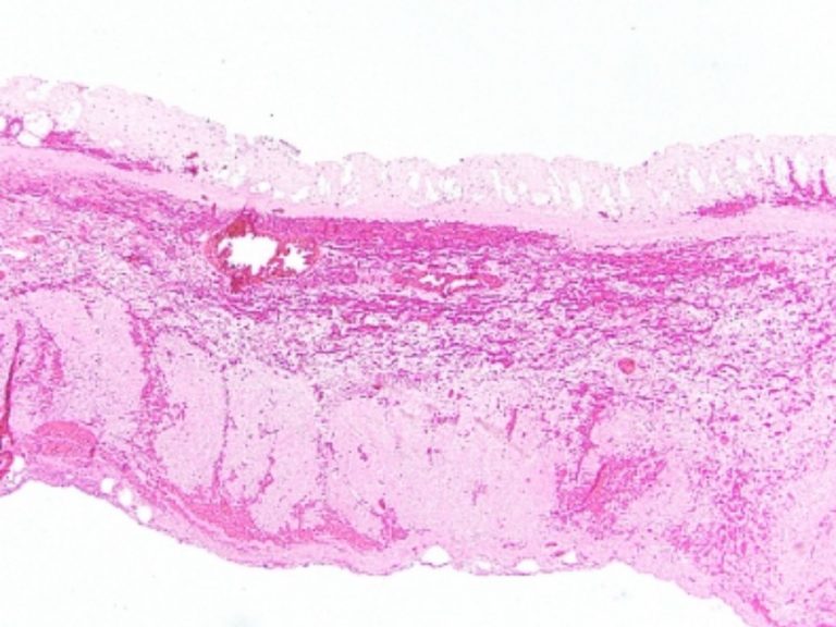 Infarto intestinale, ecco come riconoscerlo in tempo: i sintomi da non sottovalutare Infarto intestinale, ecco come riconoscerlo in tempo: i sintomi da non sottovalutare