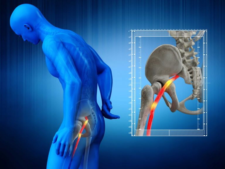 Sciatica, il Dottor Riccardo Bertoja svela: ecco alcuni semplici rimedi per alleviare il dolore