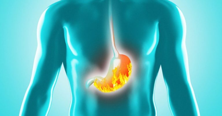 Reflusso gastroesofageo, ecco quali sono i sintomi caratteristici e quelli meno comuni Reflusso gastroesofageo, ecco quali sono i sintomi caratteristici e quelli meno comuni