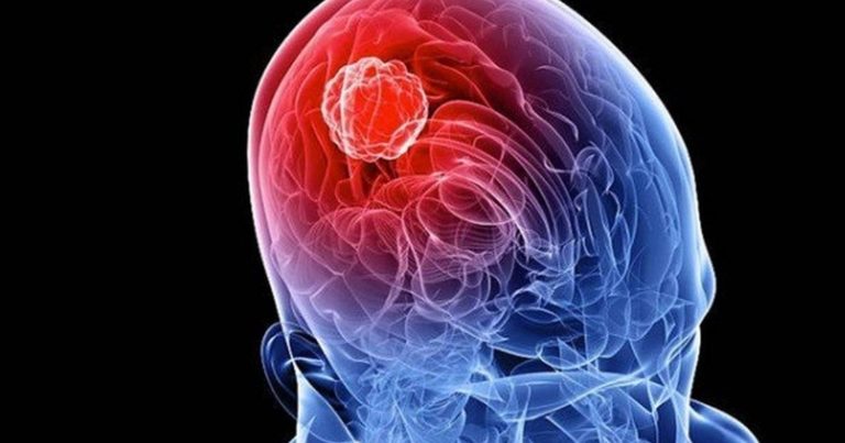 Meningite, il Professor Pier Luigi Lopalco spiega quali sono i primi sintomi ai quali prestare attenzione