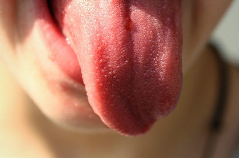Cancro alla lingua, attenzione a questi sintomi da non sottovalutare