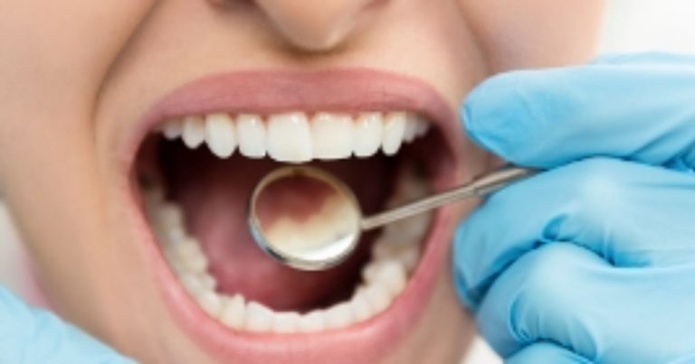 Sindrome della bocca che brucia, come riconoscere i sintomi e quali sono i trattamenti per alleviare il fastidio Sindrome della bocca che brucia, come riconoscere i sintomi e quali sono i trattamenti per alleviare il fastidio