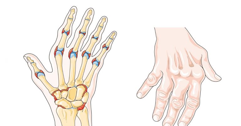 Artrite reumatoide, attenzione a questo primo “strano” sintomo. Ecco di cosa si tratta