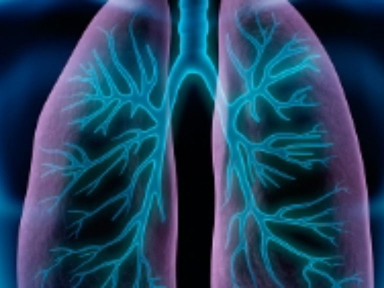 Pneumotorace, attenzione a questi sintomi da non sottovalutare Pneumotorace, attenzione a questi sintomi da non sottovalutare
