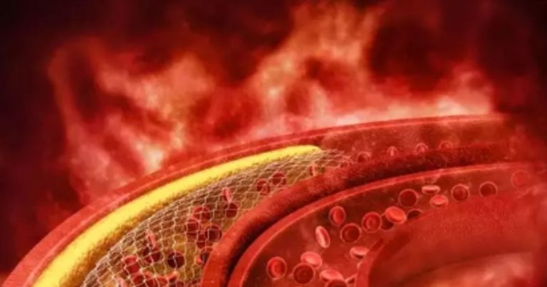 Colesterolo alto, questi sono i sintomi che devono preoccupare e che non vanno trascurati Colesterolo alto, questi sono i sintomi che devono preoccupare e che non vanno trascurati