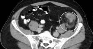 diverticolite diverticoli