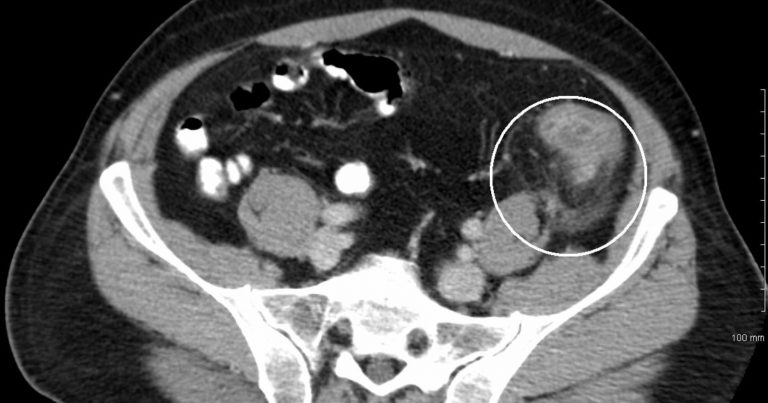 Diverticolite, attenzione a questi sintomi da non sottovalutare