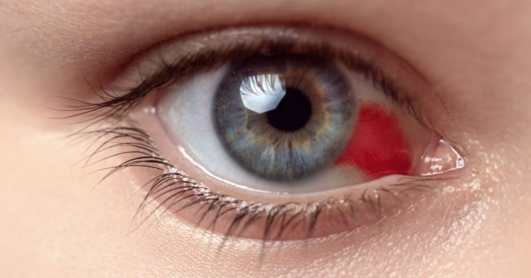 Sangue nell’occhio, a volte può rivelare questi problemi di salute: ecco cosa c’è da sapere