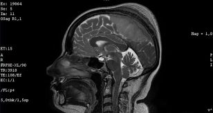 meningioma