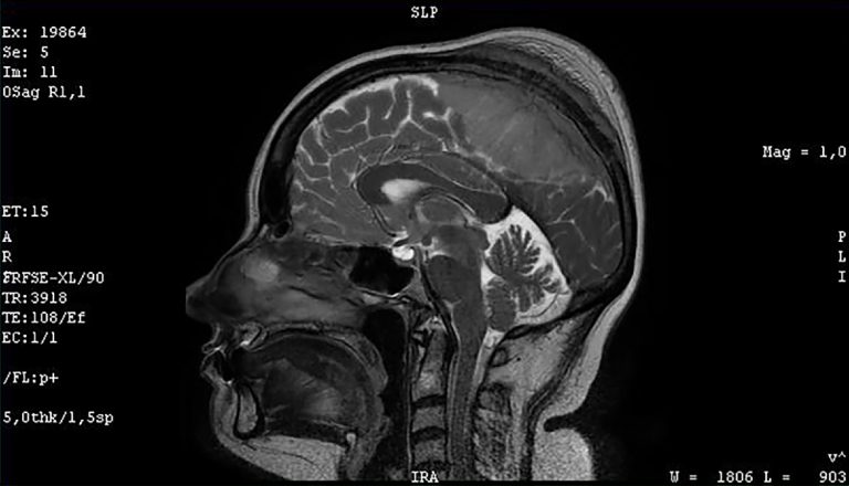 Meningioma, il prof. Pietro Mortini spiega quali sono i sintomi da non sottovalutare Meningioma, il prof. Pietro Mortini spiega quali sono i sintomi da non sottovalutare