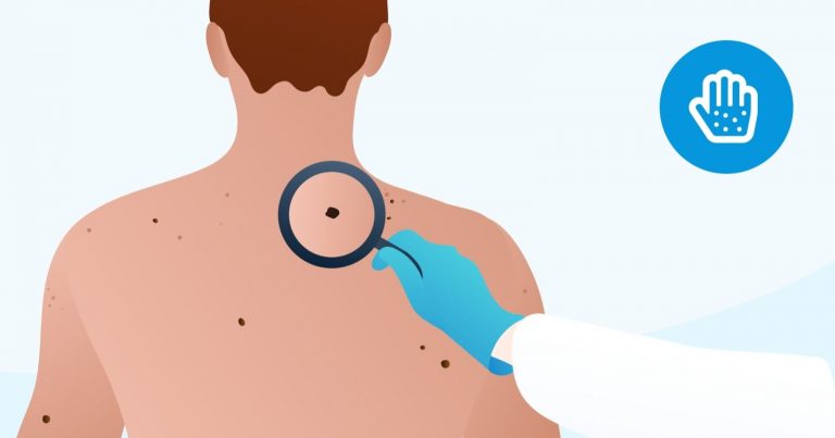 Carcinoma basocellulare, il tumore maligno della pelle più diffuso: attenzione a questi segnali per riconoscerlo Carcinoma basocellulare, il tumore maligno della pelle più diffuso: attenzione a questi segnali per riconoscerlo