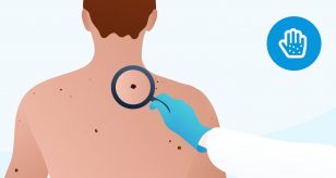 carcinoma basocellulare tumore