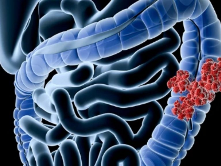 Tumore al colon, la malattia di Matteo Messina Denaro: i segnali da non sottovalutare