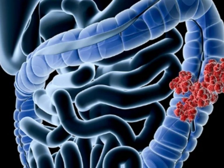 Tumore al colon-retto, il prof. Pierpaolo Sileri spiega quali sono i sintomi subdoli e quelli più evidenti Tumore al colon-retto, il prof. Pierpaolo Sileri spiega quali sono i sintomi subdoli e quelli più evidenti