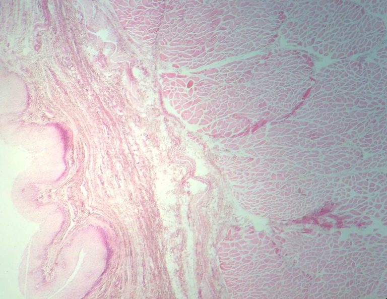 Tumore dell’esofago: attenzione a questo primo strano sintomo. Ecco quale Tumore dell’esofago: attenzione a questo primo strano sintomo. Ecco quale