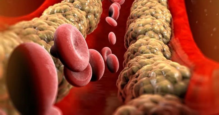 Colesterolo alto, attenzione a questi 5 sintomi che devono preoccupare e non vanno trascurati Colesterolo alto, attenzione a questi 5 sintomi che devono preoccupare e non vanno trascurati