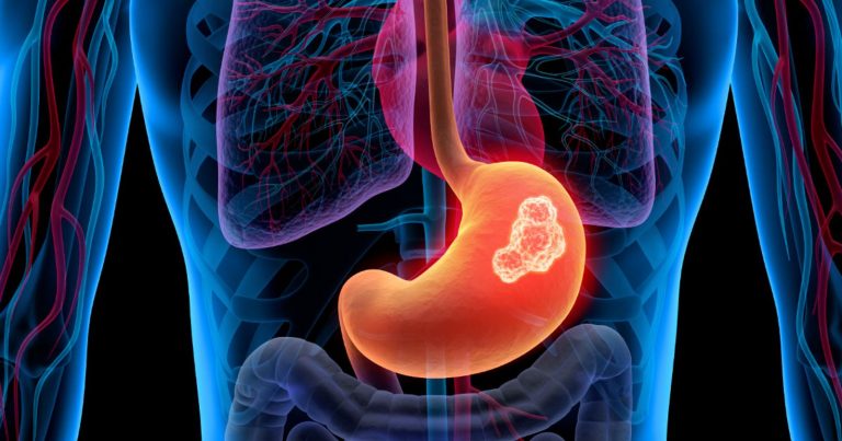 Tumori gastrointestinali, l’oncologo Francesco Cognetti: “Attenzione a questi sintomi…”