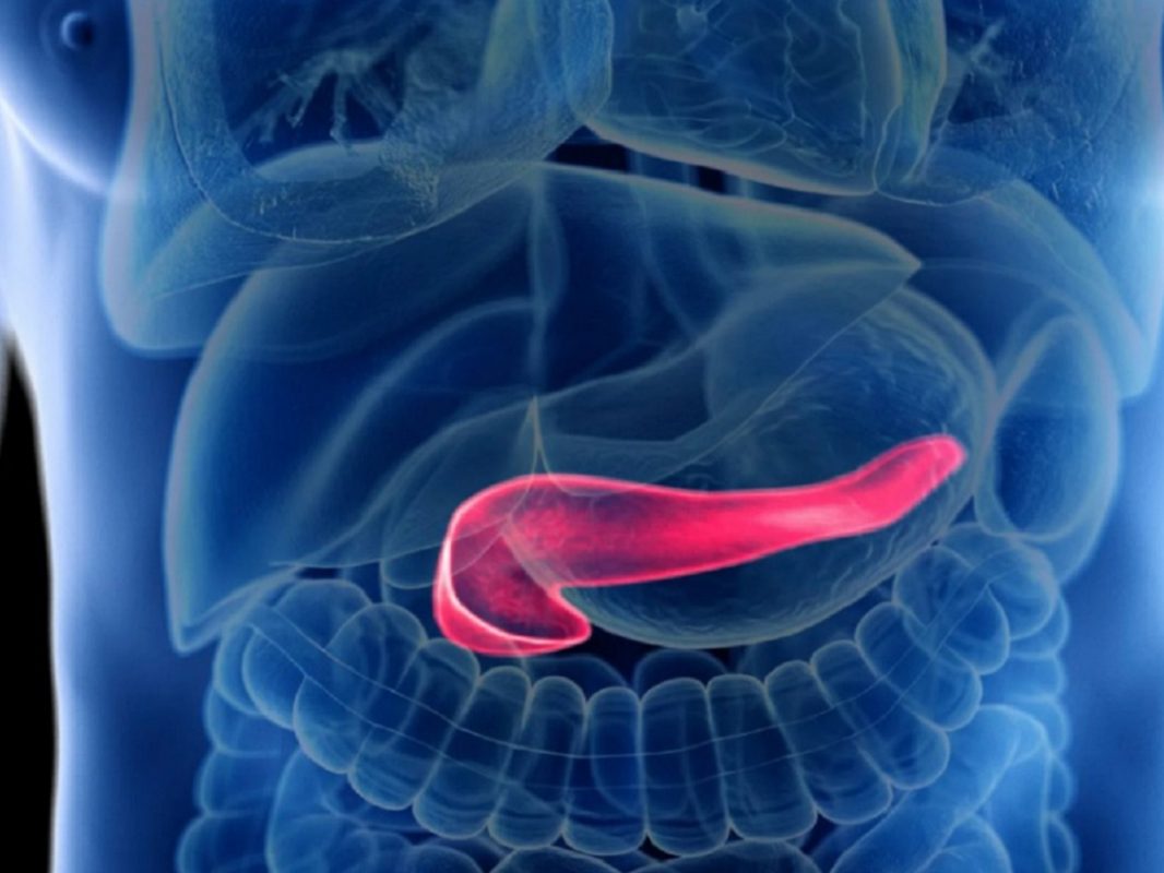 Tumore Al Pancreas Paziente 80enne Salvata Da Un Raro Tumore Al