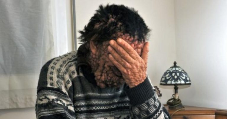 Morbo di von Recklinghausen, la malattia di Vinicio Riva: ecco qual è di solito il primo segno per riconoscerlo Morbo di von Recklinghausen, la malattia di Vinicio Riva: ecco qual è di solito il primo segno per riconoscerlo