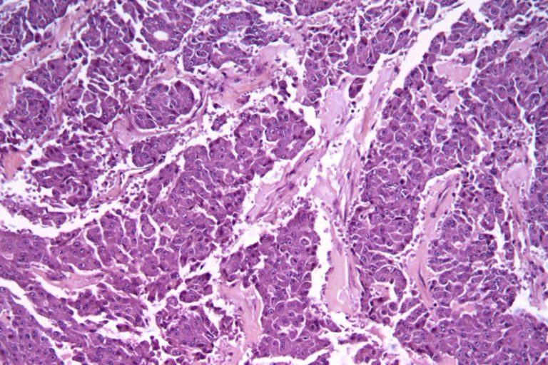 Tumore al pancreas, attenzione a questo strano sintomo: ecco come si manifesta