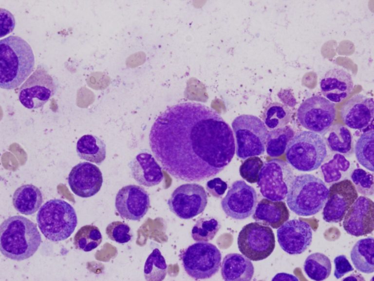 Leucemia mieloide acuta, Eleonora Bolzan è morta a 27 anni: ecco i sintomi per riconoscere la malattia Leucemia mieloide acuta, Eleonora Bolzan è morta a 27 anni: ecco i sintomi per riconoscere la malattia