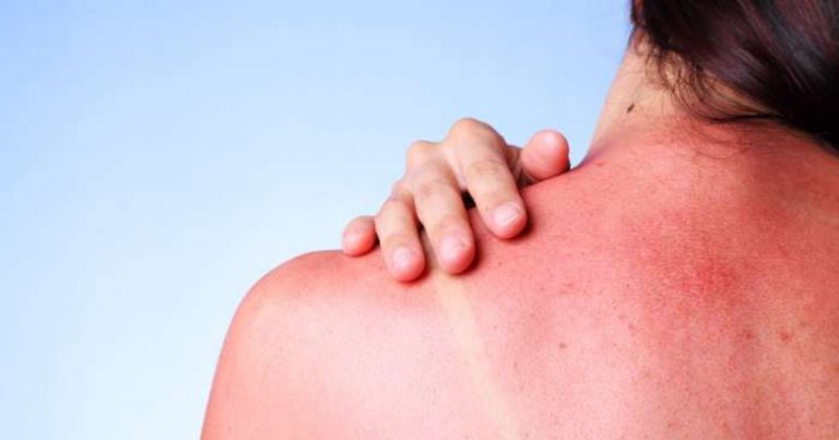 Eritema solare, il professor Ardigò spiega i sintomi e i rimedi Eritema solare, il professor Ardigò spiega i sintomi e i rimedi