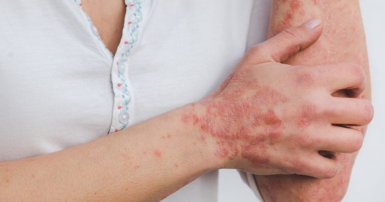 Psoriasi, scoperto un nuovo farmaco che può migliorare la vita di chi ne soffre: tutti i dettagli Psoriasi, scoperto un nuovo farmaco che può migliorare la vita di chi ne soffre: tutti i dettagli