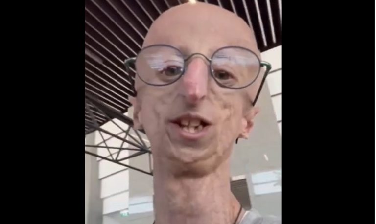 Sammy Basso morto a 28 anni, ecco cos’è la progeria, la malattia di cui soffriva