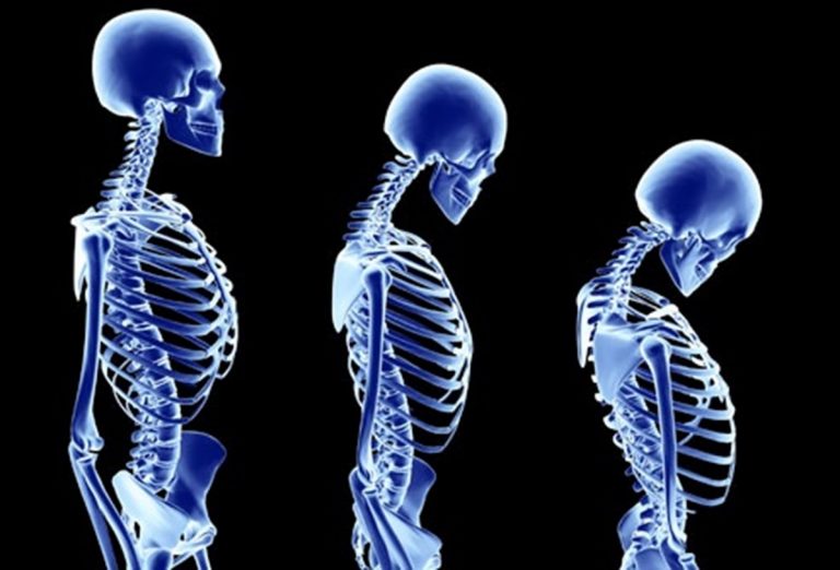 Osteoporosi, il killer silenzioso che distrugge le ossa: come prevenirlo e i sintomi da non sottovalutare