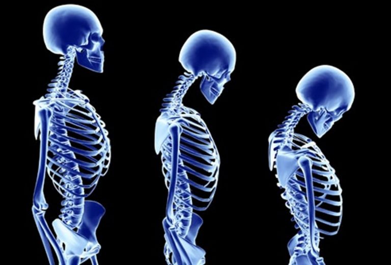 Osteoporosi, di cosa si tratta e quali sono i sintomi principali Osteoporosi, di cosa si tratta e quali sono i sintomi principali