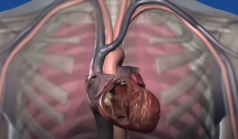 Defibrillatore sottocutaneo rimovibile di Bove, a cosa serve e come